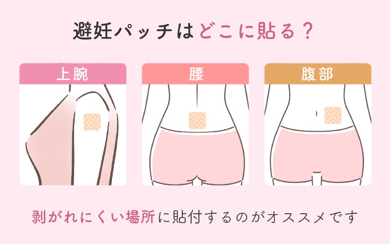 避妊パッチを貼る場所はどこ？