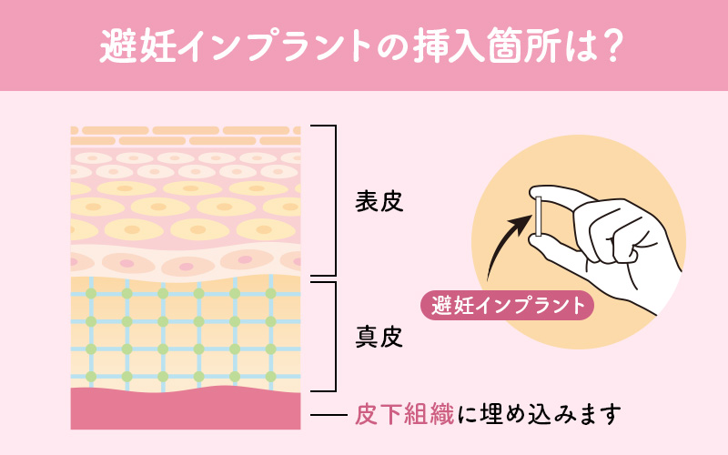 避妊インプラントは二の腕の皮下組織に挿入