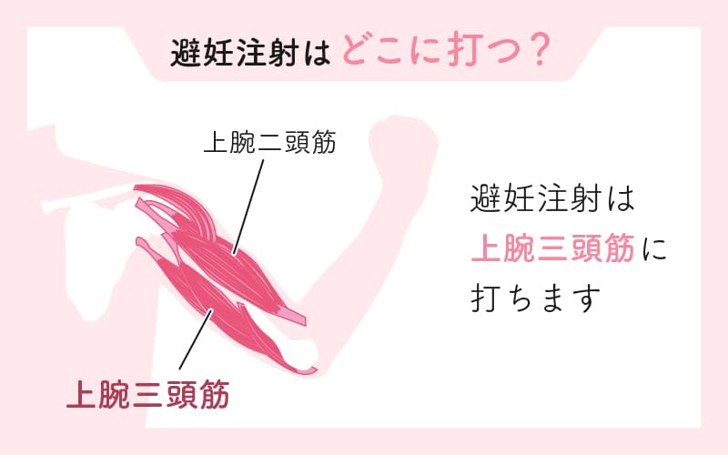 避妊注射の打つ部位