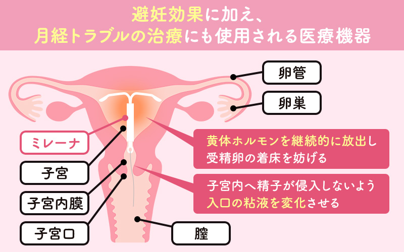 ミレーナとは?避妊や月経トラブルの治療が可能