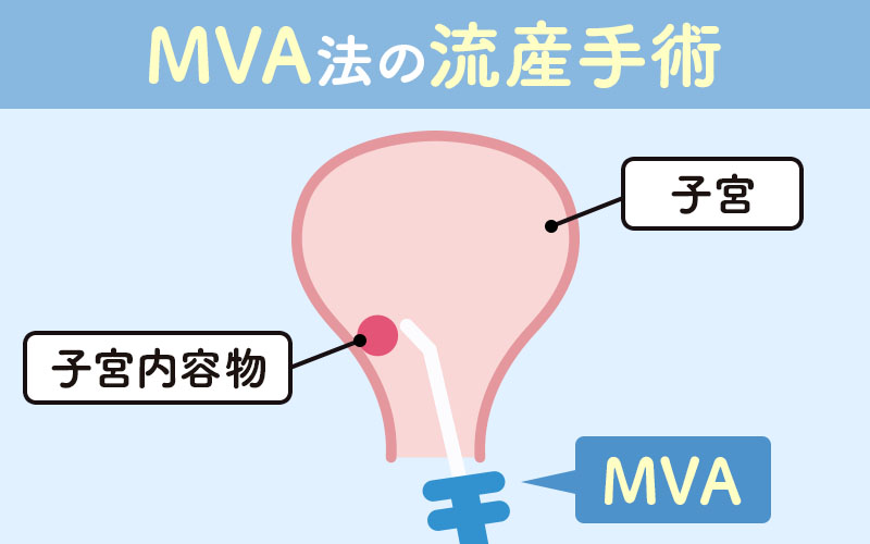 MVA法(手動吸引法)による流産手術