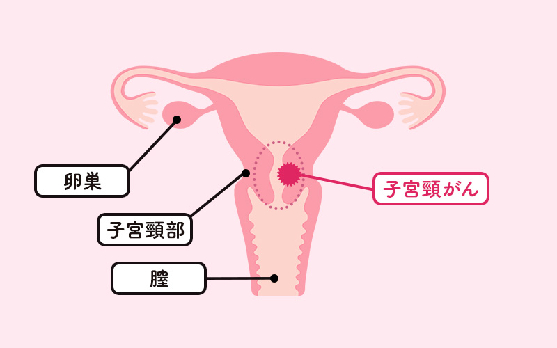 子宮頸がんワクチン(HPVワクチン)